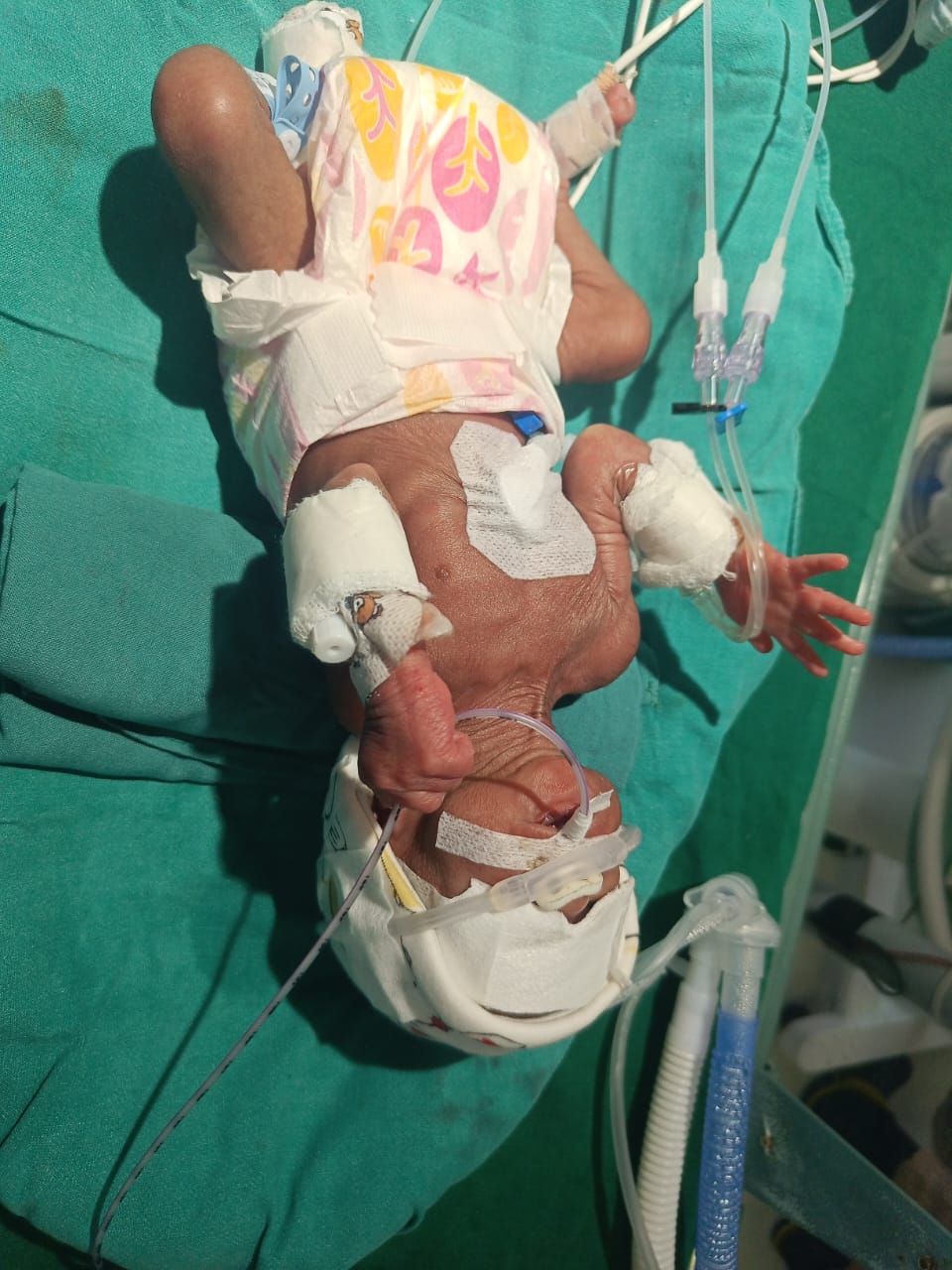 Premature Baby